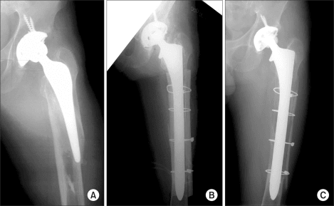 Three-panel radiographs of revision THA for a periprosthetic femoral fracture: preoperative fracture with femoral bone defect, postoperative long revision stem with cerclage cables, and follow-up