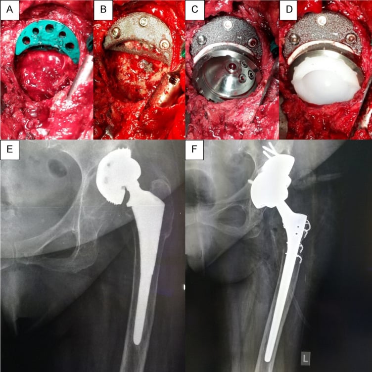 Six-panel operative and radiographic sequence showing trial and screw fixation of a trabecular metal augment, porous cup insertion and follow-up