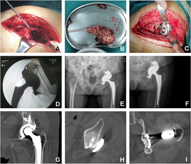 Nine-panel sequence showing acetabular defect exposure, spacer removal, custom triflange implantation, fluoroscopy and postoperative radiographic and CT follow-up