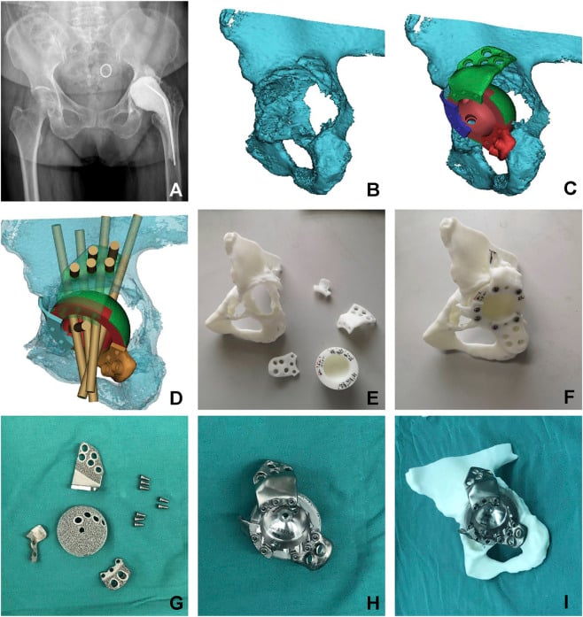 Nine-panel custom triflange workflow showing radiograph, three-dimensional acetabular reconstruction, screw trajectory planning, printed models and final implants