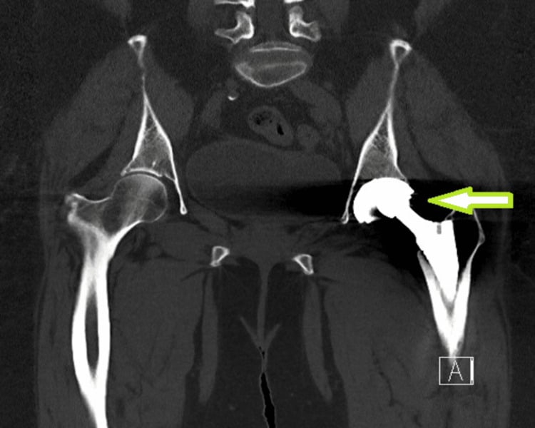 Coronal CT showing eccentric lateral position of the femoral head component within a left dual-mobility acetabular shell