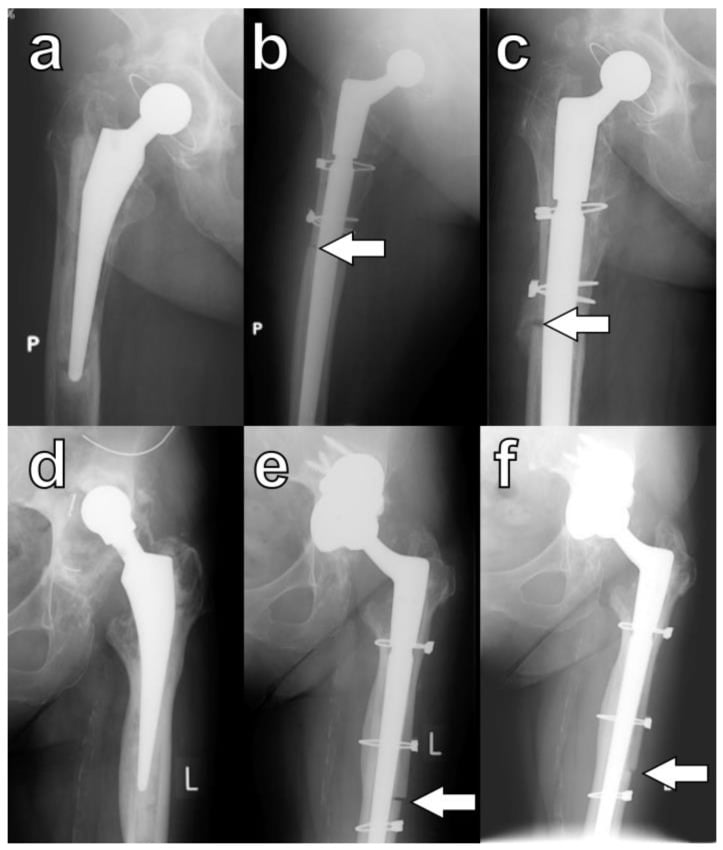 Serial radiographs after extended trochanteric osteotomy showing progressive callus and cortical bridging around cable fixation