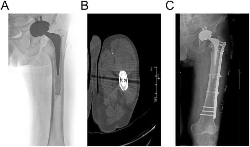 Three-panel series showing a subtle proximal femoral lucency on radiograph, axial CT confirmation of periprosthetic fracture, and postoperative plate-and-cable fixation