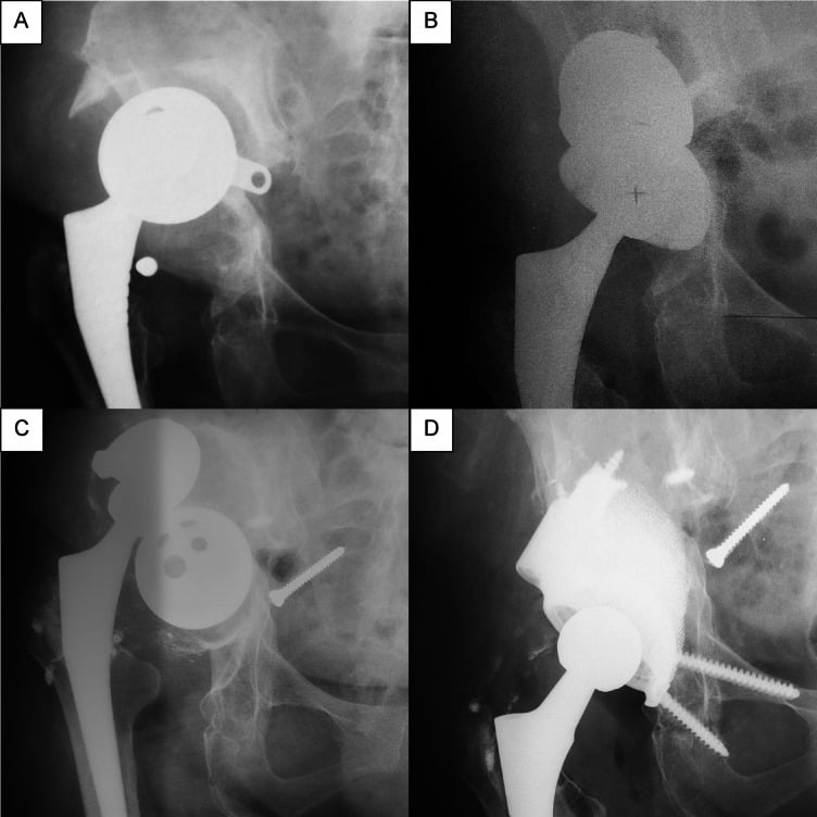 Four-panel radiographic series of severe superior acetabular component migration reconstructed with porous cup and metal augments