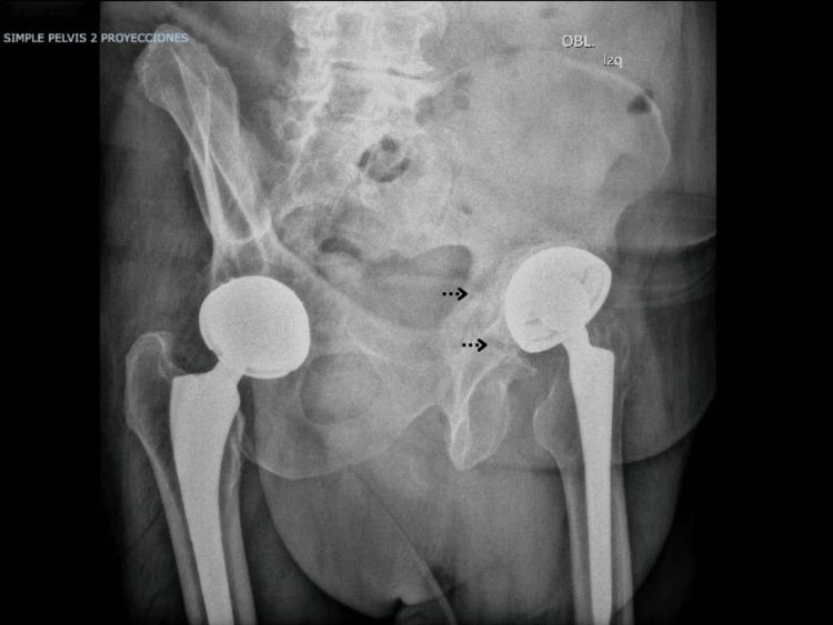 Judet oblique pelvic radiograph showing a transverse fracture line and acetabular bone loss around a left total hip arthroplasty