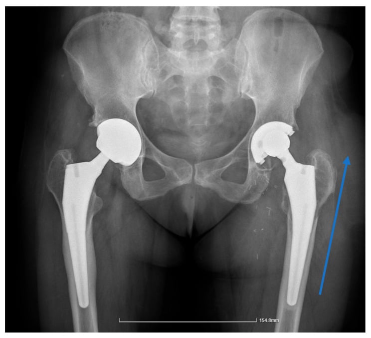 AP pelvic radiograph showing bilateral total hip arthroplasties with eccentric femoral head position and acetabular osteolysis on the left