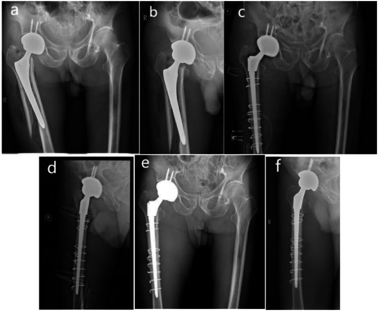 Six-panel radiographic series of a Vancouver B2 periprosthetic femoral fracture treated with modular revision stem and cerclage wires