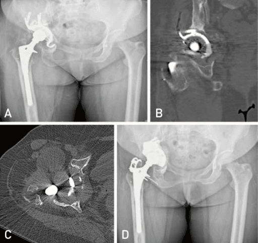Pelvic discontinuity and porous augment revision THA reconstruction