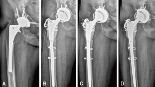 Proximal femoral bone loss revision stem reconstruction