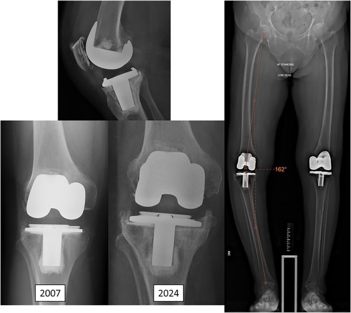 Standing full-length and knee radiographs showing progressive tibial tray subsidence and varus alignment before revision TKA