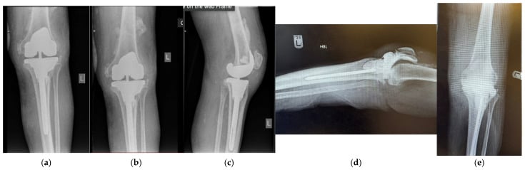 Radiographs showing an antibiotic spacer during two-stage revision of an infected knee