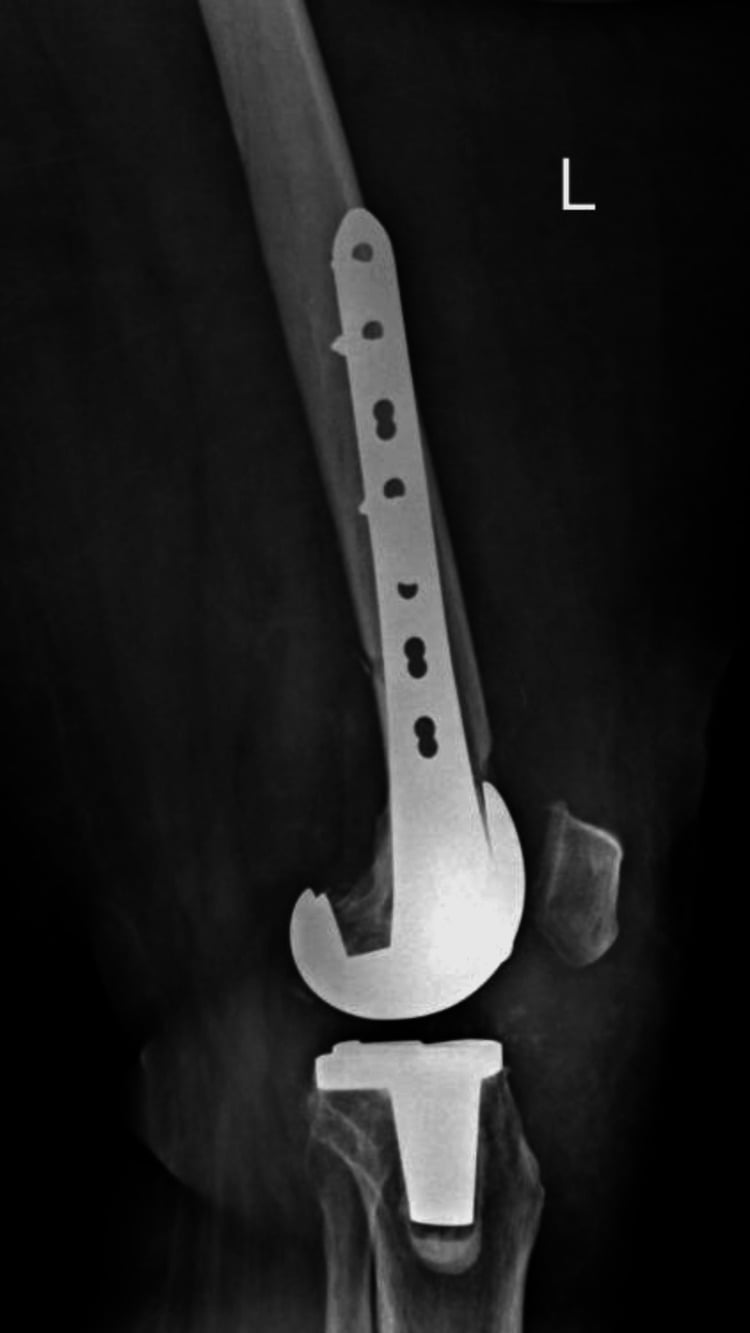 Lateral femur radiograph after locking-plate fixation of a periprosthetic distal femoral fracture complication above TKA