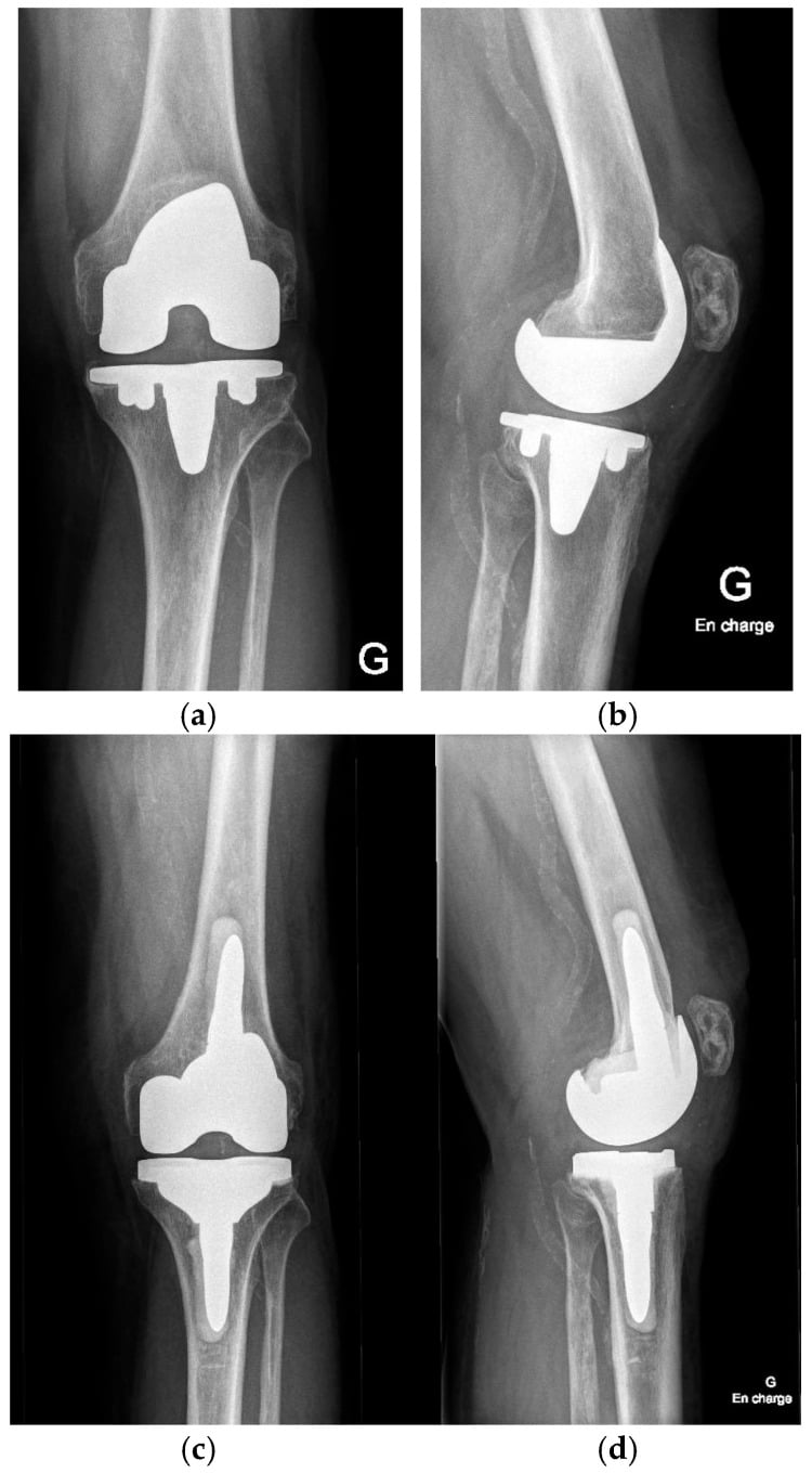 Preoperative and postoperative AP and lateral knee radiographs after revision for aseptic loosening