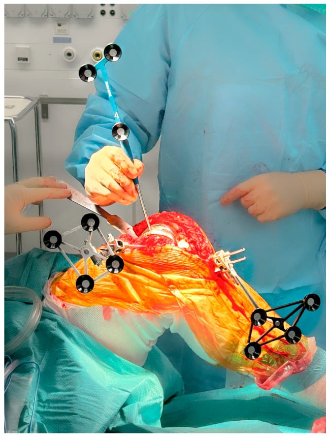 Intraoperative revision TKA exposure with femoral and tibial tracker pins