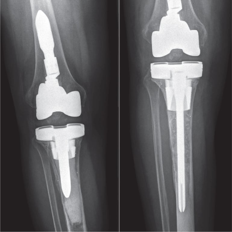 AP radiographs showing tibial component loosening before and after revision knee arthroplasty