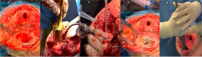 Operative sequence showing an AORI 2B tibial defect, cone preparation, impaction and stability testing