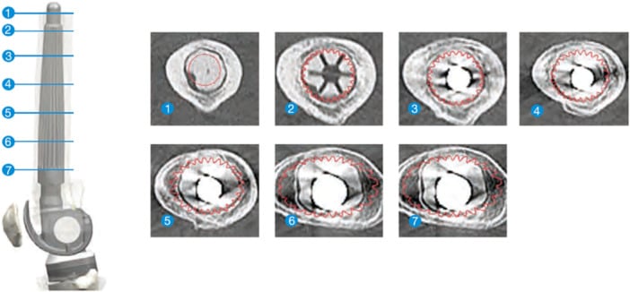 CT-based axial planning of a customised femoral revision implant