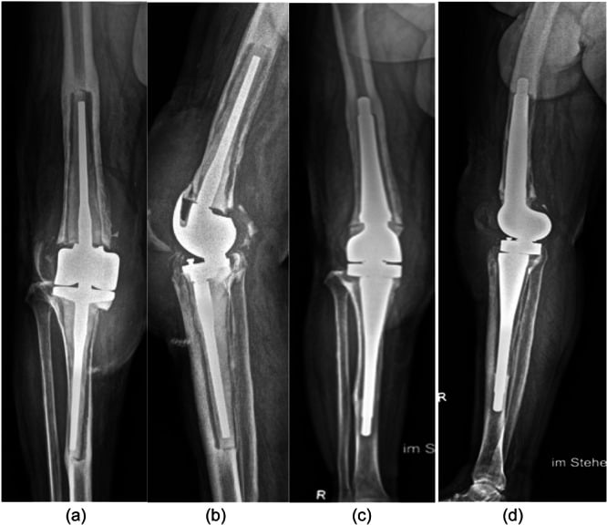 Preoperative and postoperative radiographs of customised femoral and tibial revision implants