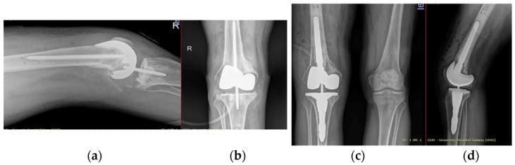 Serial radiographs of a customised knee spacer and final revision reconstruction for periprosthetic joint infection