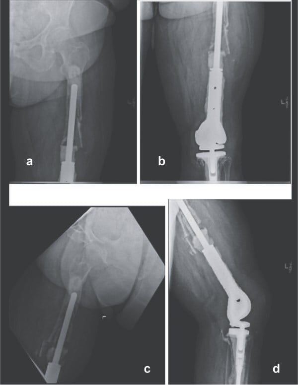 Radiographs showing loosening and extensive femoral bone loss after repeated distal femoral replacement revision