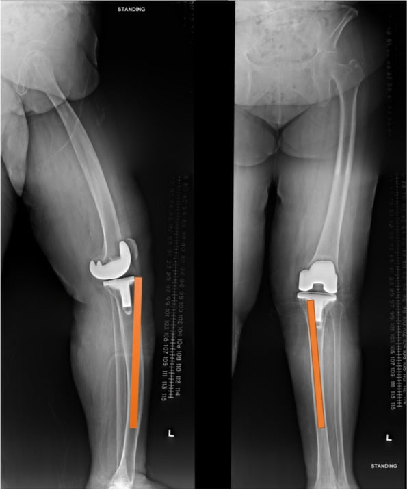 Long-leg radiographs demonstrating mismatch between the metaphysis and diaphyseal canal in revision knee arthroplasty