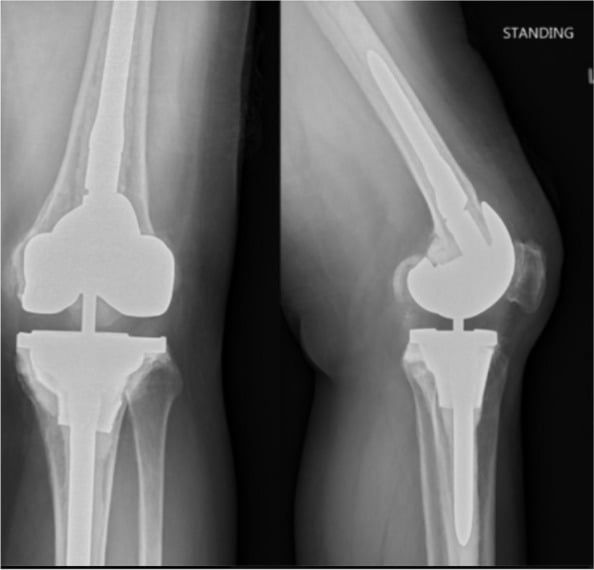 Anteroposterior and lateral radiographs after revision knee arthroplasty with a tibial metaphyseal cone