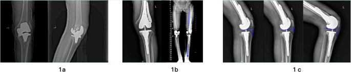Radiographic example of metaphyseal sleeve reconstruction in revision TKA