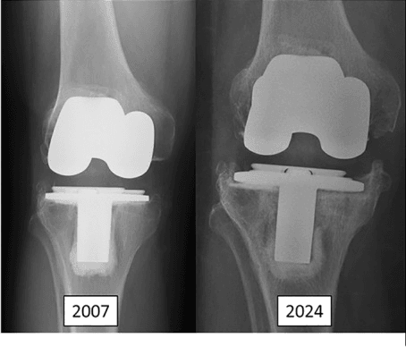 Serial knee radiographs showing progressive tibial tray subsidence between 2007 and 2024