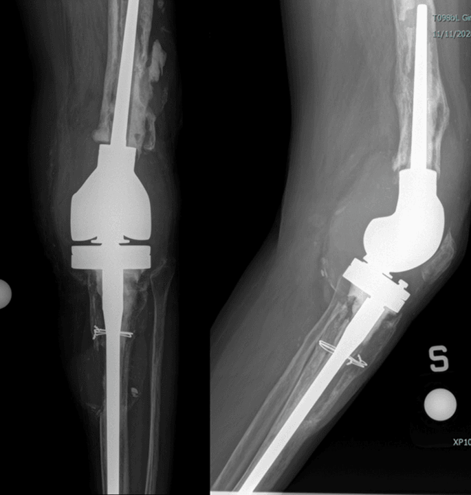 Radiographic example of revision TKA failure with severe bone loss and stemmed construct