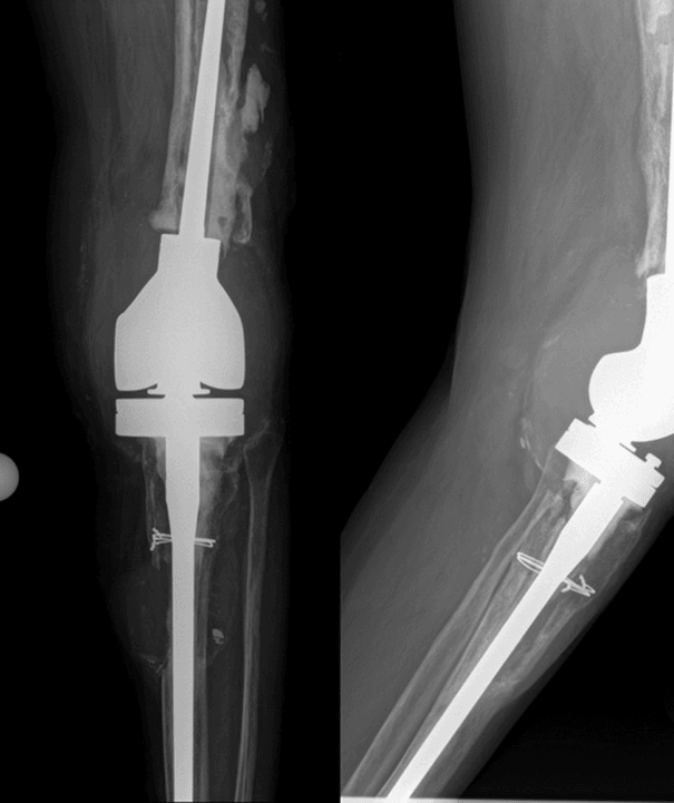 Radiographic example of revision TKA failure with severe bone loss and stemmed construct