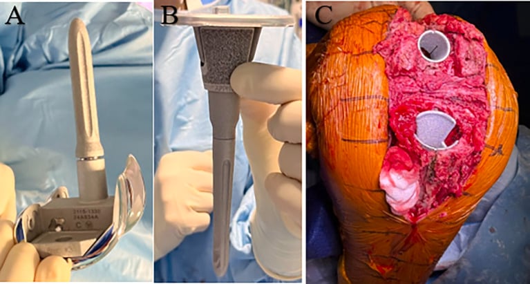 Stemmed femoral and tibial revision components and porous metaphyseal cones seated in host bone at operation