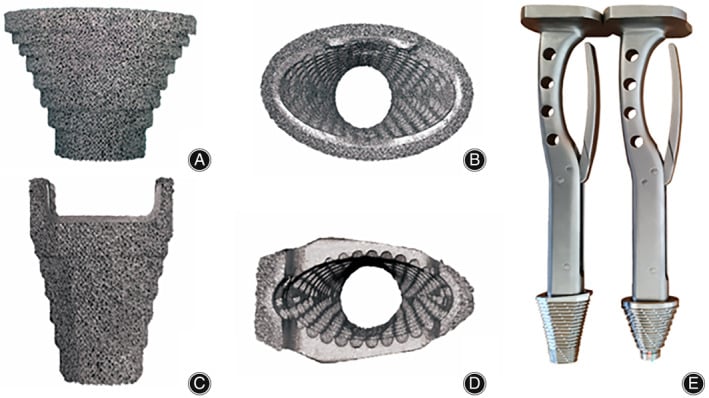 Frontal and top view of 3D-printed porous titanium metaphyseal stepped cone
