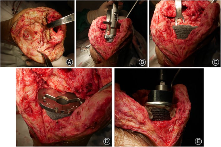 Schematic diagram of intraoperative reaming and positioning for metaphyseal cone