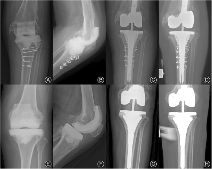 Preoperative and postoperative AP and lateral radiographs of revision TKA with metaphyseal cone