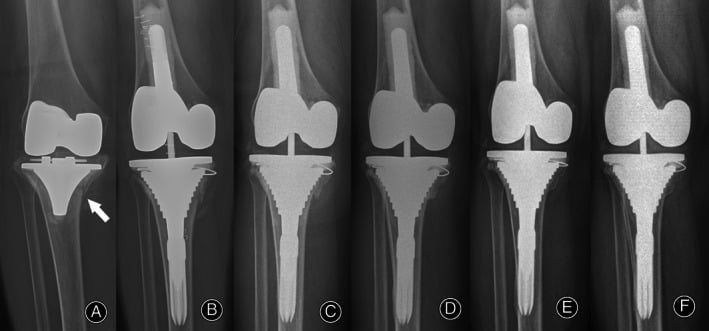 Postoperative AP and lateral radiographs demonstrating metaphyseal sleeve osseointegration
