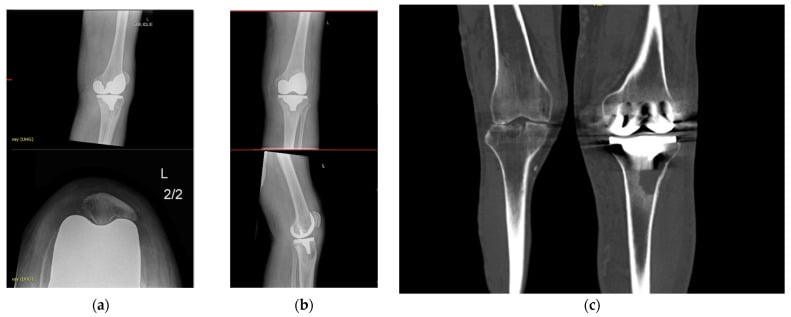 Knee radiographs and CT demonstrating a major tibial bone defect before revision arthroplasty