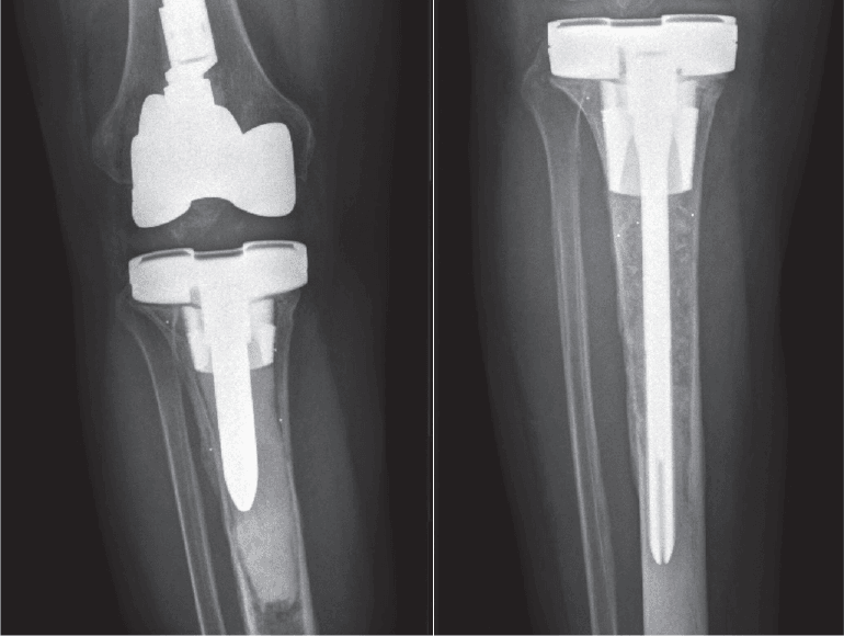 Radiographs of tibial cone loosening before re-revision and stable reconstruction six weeks later