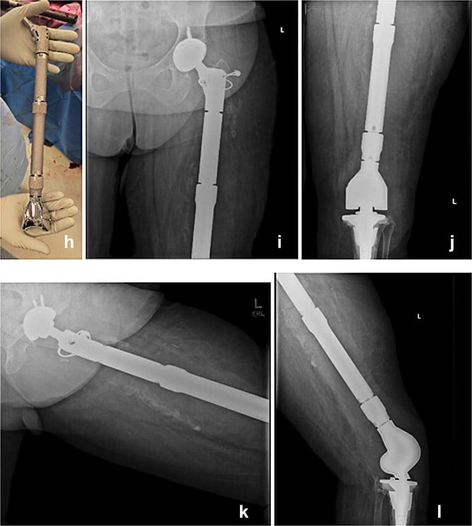 Modular total femur replacement and postoperative radiographs with a rotating-hinge knee