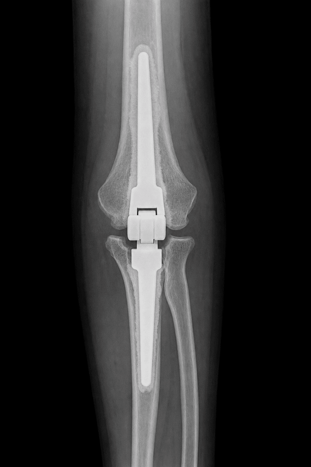 AP radiograph of a linked total elbow arthroplasty with humeral and ulnar stems and a central hinge