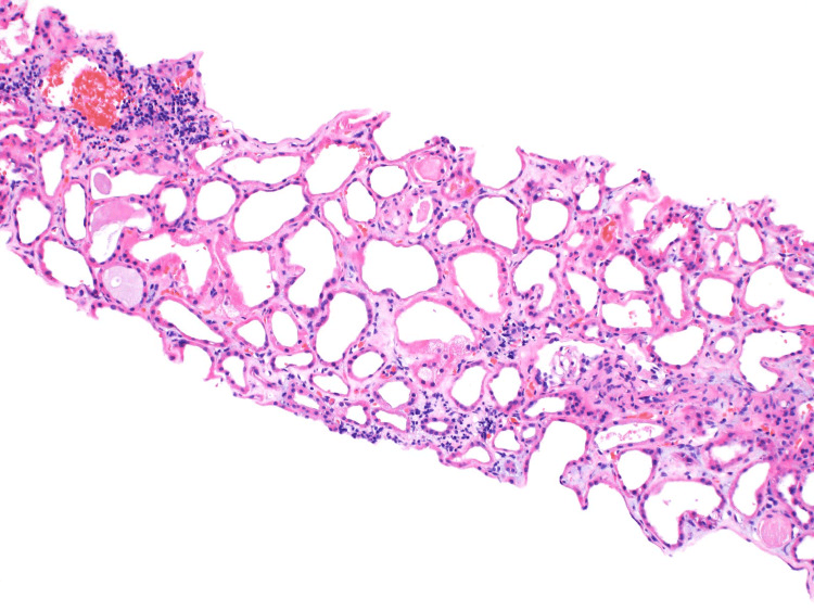 Renal biopsy showing acute tubular epithelial injury