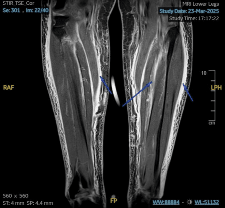 Coronal STIR MRI showing bilateral muscle oedema in autoimmune rhabdomyolysis