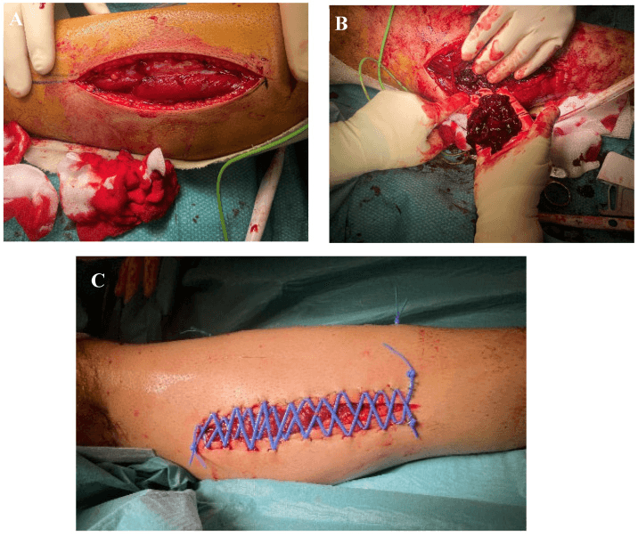 Operative photographs from a two-incision four-compartment leg fasciotomy: one wound, clot evacuation and shoelace closure