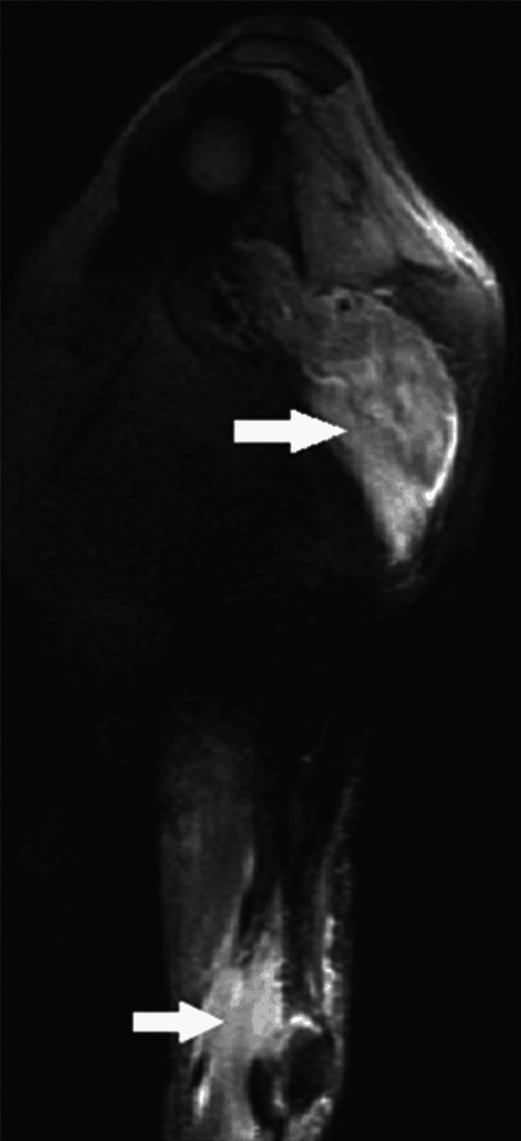 Arm and shoulder MRI showing inflammatory myopathy