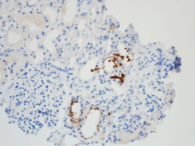 Renal biopsy immunostain showing myoglobin positive casts