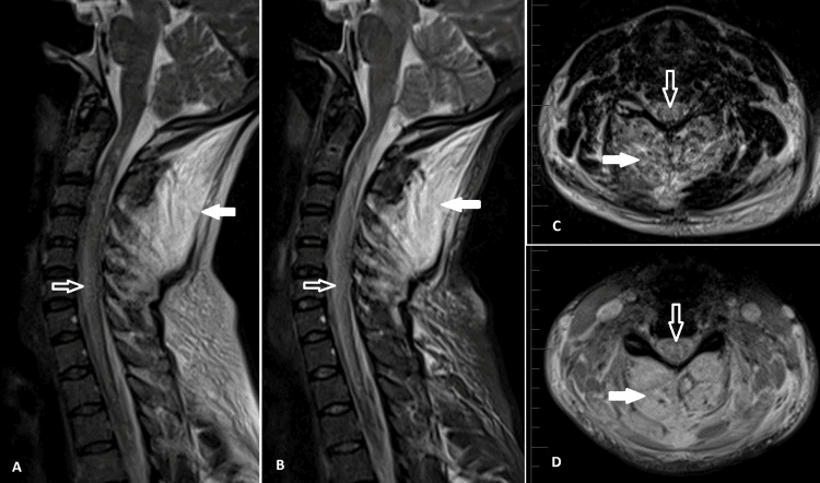 Cervical MRI showing paraspinal rhabdomyolysis and cord oedema