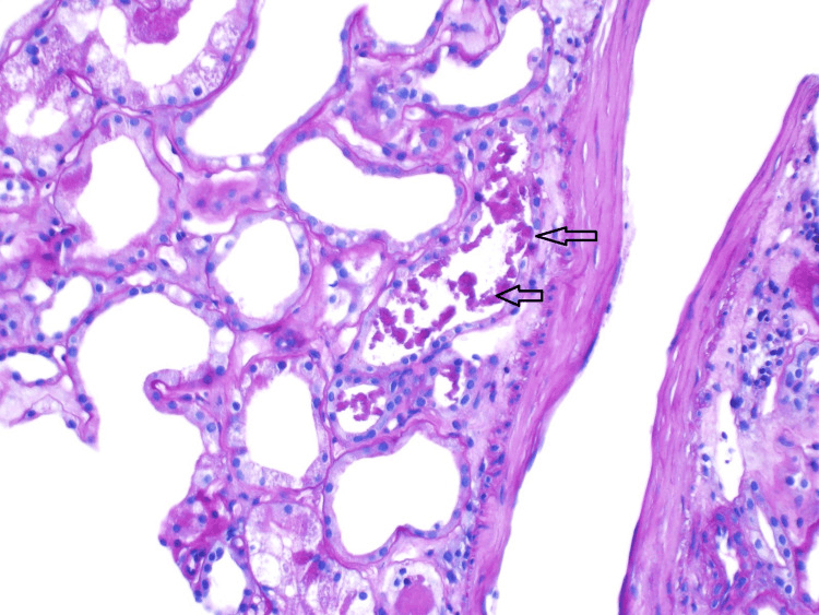 Renal biopsy showing pigmented tubular casts