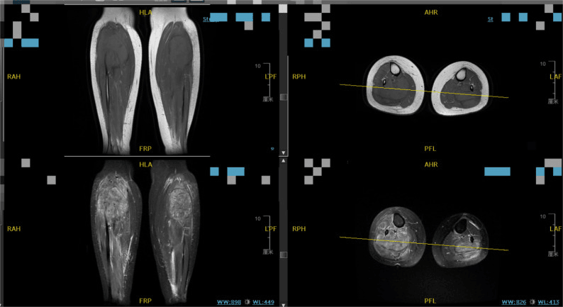 Lower limb MRI showing positioning related rhabdomyolysis