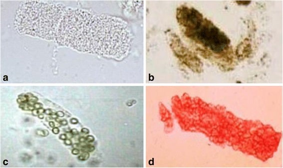 Urine microscopy showing renal tubular epithelial cell cast, muddy brown granular cast, WBC cast and RBC cast