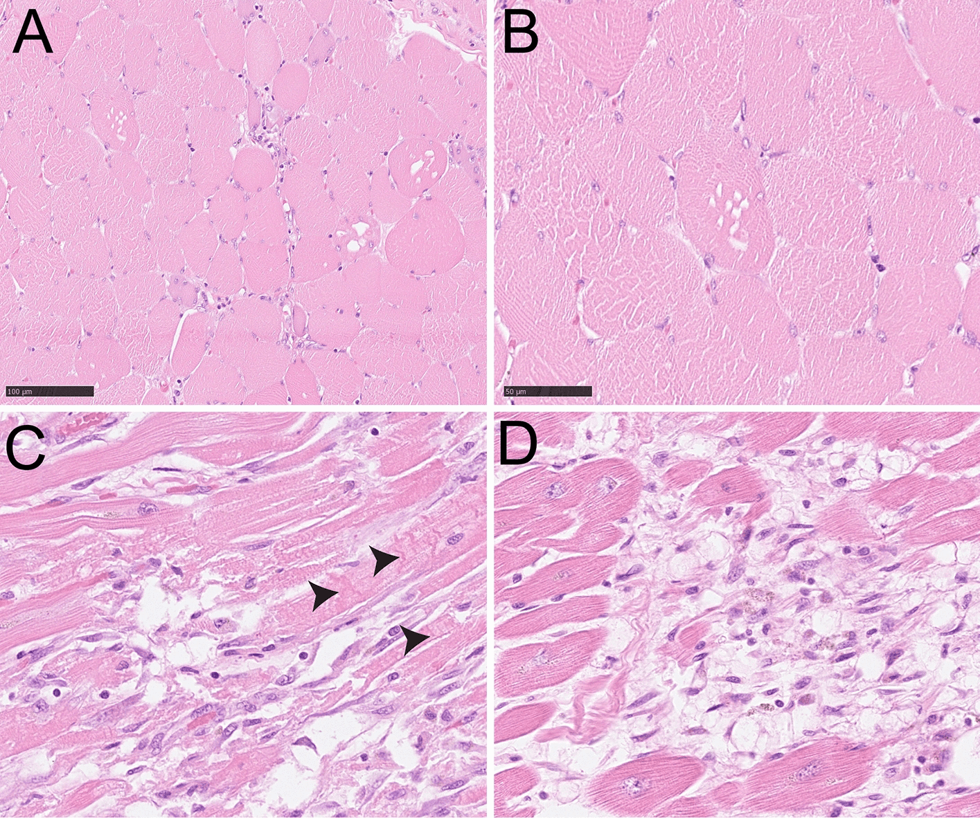 Skeletal and cardiac muscle histology showing vacuolation and contraction bands
