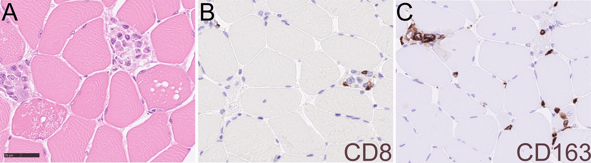 Skeletal muscle histology showing necrosis and immune infiltrates